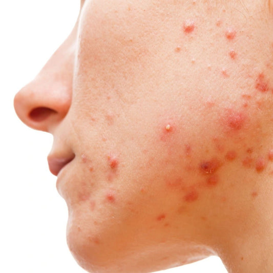 Does collagen cause pimples and acne breakouts?